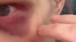 Hurting My Own Bruise